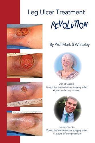 Read Leg Ulcer Treatment Revolution, written by Mark S Whiteley Read Leg Ulcer Treatment Revolution, written by Mark S Whiteley