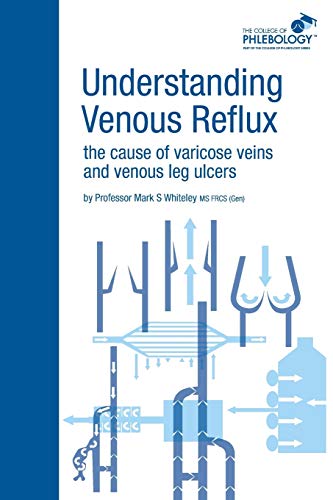 Read Understanding Venous Reflux the Cause of Varicose Veins and Venous Leg Ulcers: Varicose veins and venous leg ulcers (College of Phlebology), written by Mark S Whiteley Read Understanding Venous Reflux the Cause of Varicose Veins and Venous Leg Ulcers: Varicose veins and venous leg ulcers (College of Phlebology), written by Mark S Whiteley